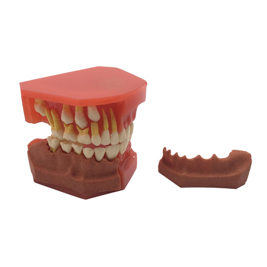 Dental Kid's Teeth Model Dental Caries Standard Teeth Teaching