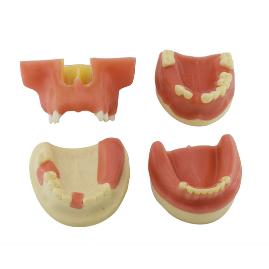 Dental Teaching Implant Practice Model Dentist Practice Replacement Model