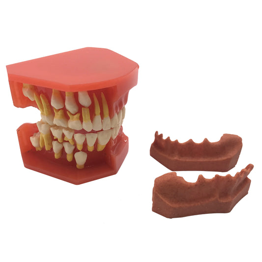 Dental Model Dental Caries Standard Teeth Teaching Dental Kid's Teeth Model